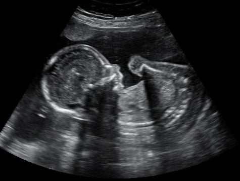 Gender Confirmation After SneakPeek Clinical Testing